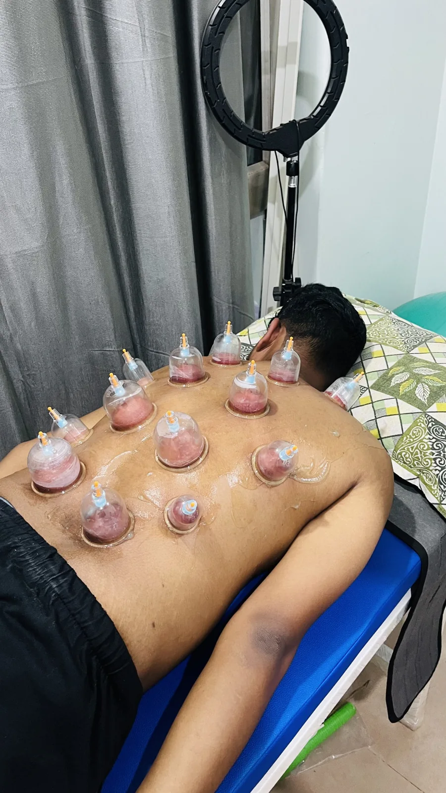 Dry cupping therapy on the back