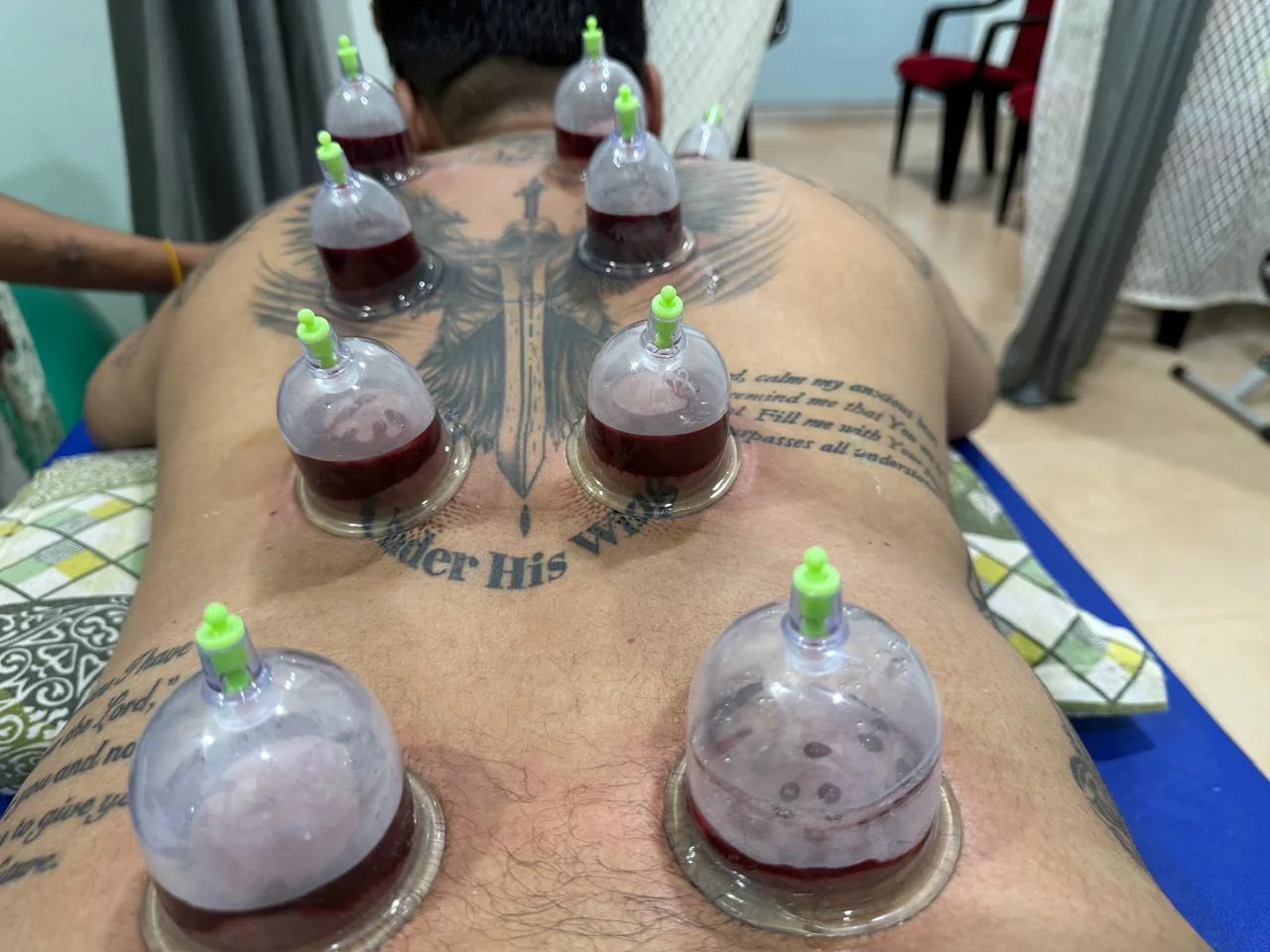 Wet cupping treatment close-up